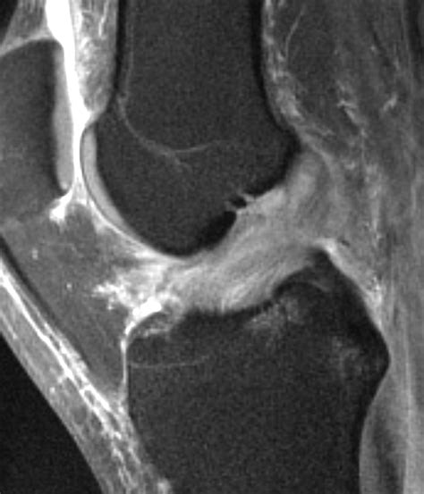 Traitements Des L Sions Ligamentaires Du Genou