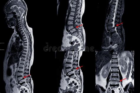 MRI of Lumbar Spine Showing Cervical Spondylosis with Mild To Moderate ...