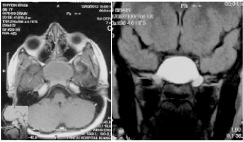 Paranasal Sinus Mucoceles Opthalmic Manifestations Radiological