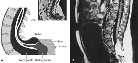 Neural Tube Development Neupsy Key