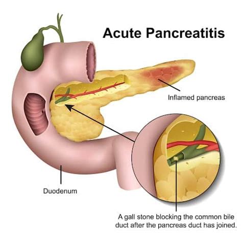 Pancreas Alpine Surgical Practice Colorectal Surgeon Lipoma Removal Colonoscopy