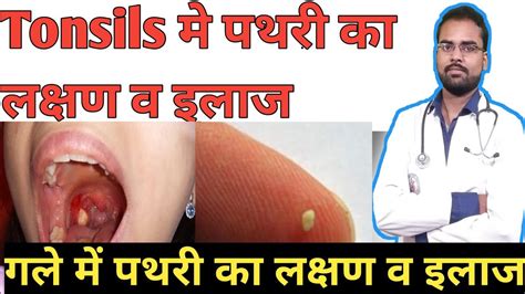 गल म पथर Tonsils me pathri ka ilaj Tonsils me stone Gale me