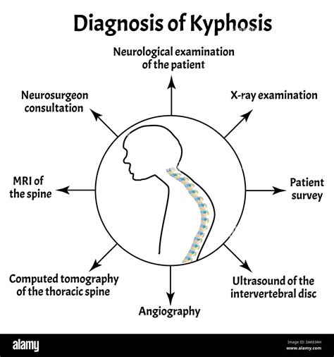 Diagnosis Of Kyphosis Spinal Curvature Kyphosis Lordosis Scoliosis