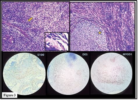 Histopathology Slides Showing A Cellular Tumor Composed Of Spindle