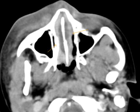 Nasal Septal Abscess-CT - Sumer's Radiology Blog