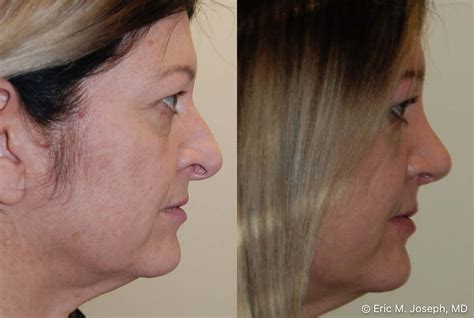 Eric M Joseph Md Rhinoplasty Before And After Hanging Columella