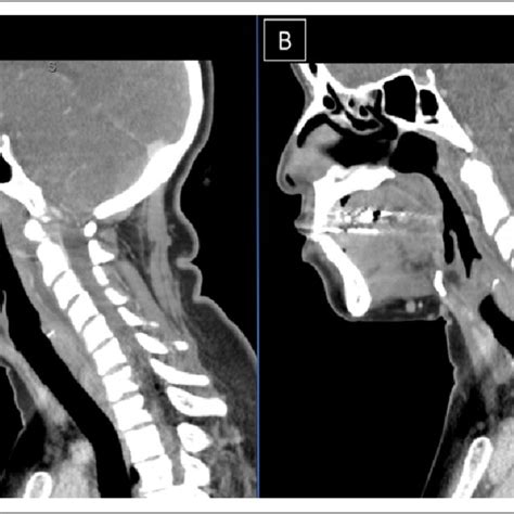 Ct Soft Tissue Neck With Contrast Comparison At Presentation And 3 Day Download Scientific