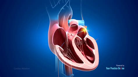 Cardiac Ablation Video | Medical Video Library