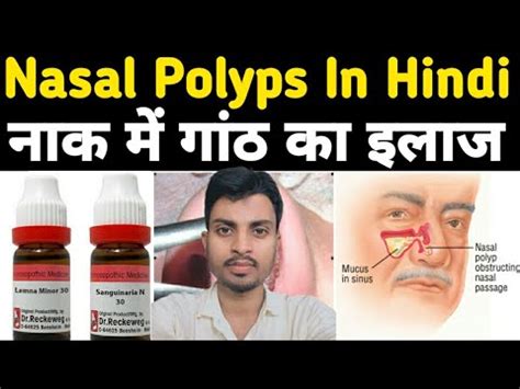 Nasal Polyps Homeopathic Medicine Nasal Polyps