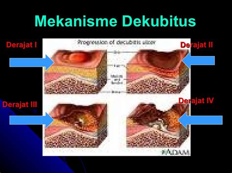 Patofisiologi Dekubitus - vrogue.co