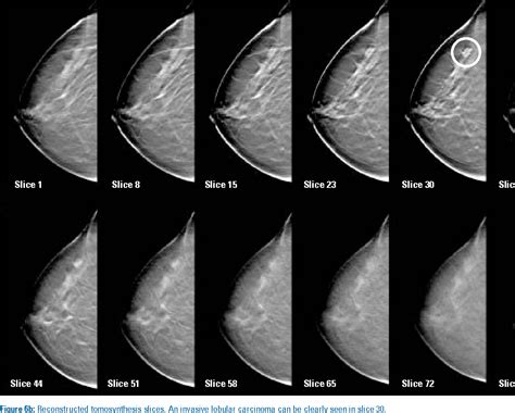 PDF Full Field Breast Tomosynthesis Semantic Scholar