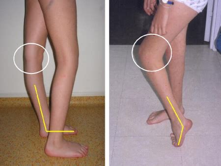 Flexion Deformity Of The Knee Physiopedia