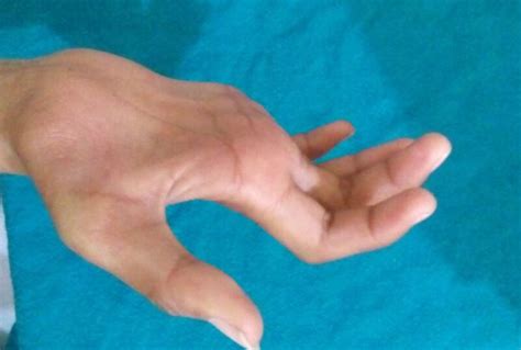 Ulnar Claw Hand