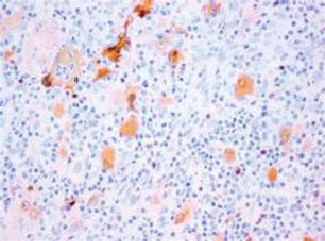 A Haematoxylin And Eosin Stain ×100 Magnification Showing Sheets Of