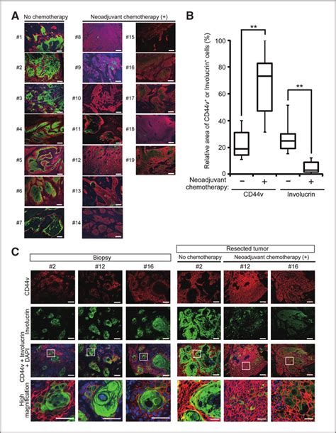 Cd V Expression In Hnscc Tumors A Hnscc Tumor Sections From Patients