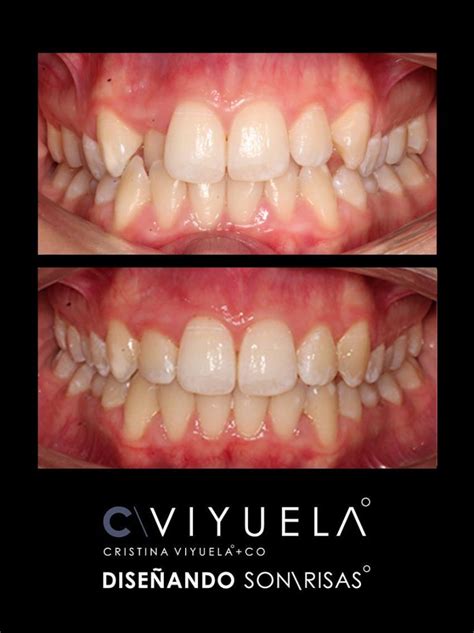 Invisalign Antes Y Después Clínicas Dra Cristina Viyuela CO