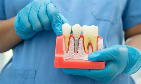 What Factors Affect Dental Implant Success