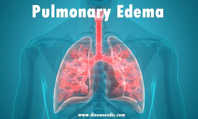 Pulmonary Edema Signs And Symptoms