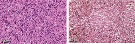 A Well Differentiated Leiomyosarcoma From A Rat Showing Interwoven