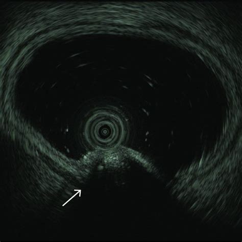 Endoscopic Ultrasonography Showing A Homogeneous Hypoechoic Lesion And Download Scientific