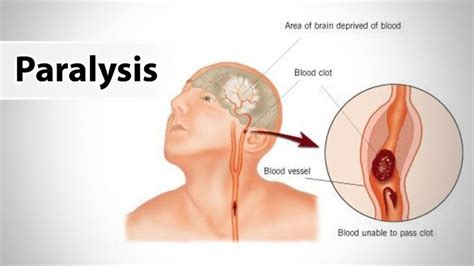 Paralysis - Nidanam Wellness