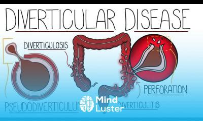 Learn Understanding Diverticular Disease Diverticulosis Vs