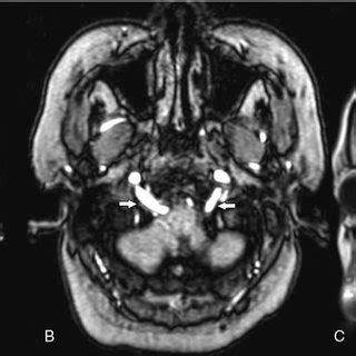 Brain MRI showing bilateral dilated hypoglossal canals, with PHAs ...