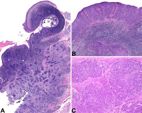 Nonkeratinizing Opscc P16 Positive A The Majority Of The Tumor Shows A Download Scientific