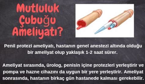 Mutluluk çubuğu nedir 3 parçalı penil protez fiyatları