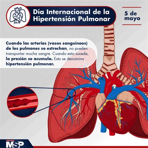 Día Mundial De La Hipertensión Pulmonar