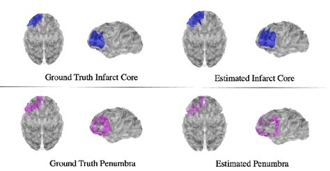 Figure From Eeg Source Imaging Of Infarct Core And Penumbra For