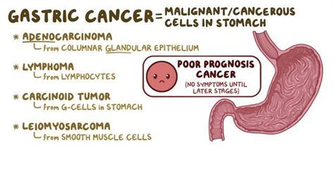 Carcinoma Of Stomachwhat To Know