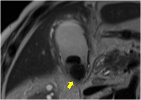 Presence Of Cystic Duct Stone Is A Risk For Postoperative Retained Stones In Patients With Acute