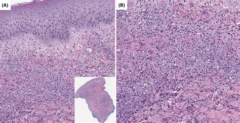 Sweet Syndrome Histopathology