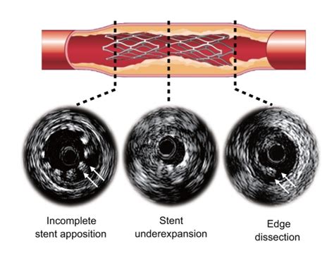 Stent-related complications after stent deployment. | Download ...