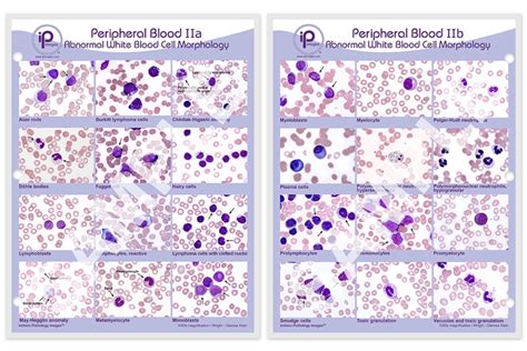 Peripheral Blood II Abnormal White Blood Cell Morphology