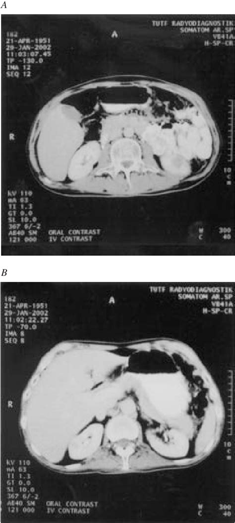 Figure From A Case Of Isolated Bilateral Renal Metastases From