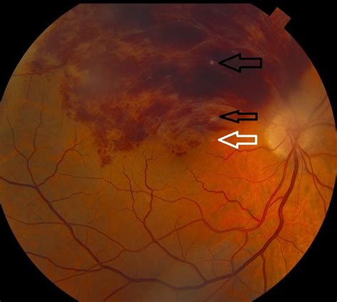 Branch Retinal Vein Occlusion in a Patient With Familial Hyperlipidemia ...