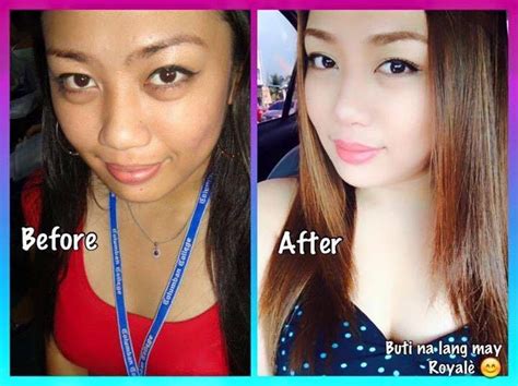 Glutathione Before And After Pictures - New Product Review articles ...