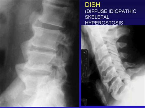 Diffuse Idiopathic Skeletal Hyperostosis