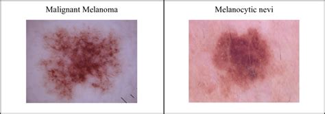 Side By Side Comparison Of Malignant Melanoma And Melanocytic Nevi