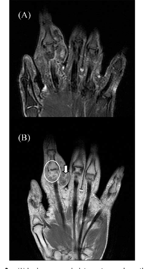 Figure From Bizarre Parosteal Osteochondromatous Proliferation On A