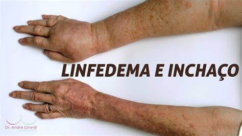 Linfedema E Os Cuidados O Bra O Ap S Tratamento Oncol Gico Youtube