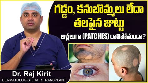 జుట్టు పట్టీల రాలితే Alopecia Areata Causes And Symptoms Patchy Hair Loss Celestee Hair