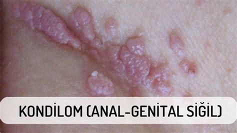 Kondilom Anal Genital Siğil Nedir Nasıl Tedavi Edilir