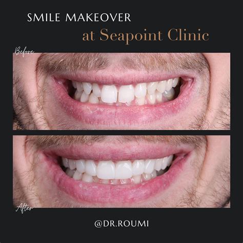 Transform Your Smile with Composite Veneers: The Ultimate Guide to ...