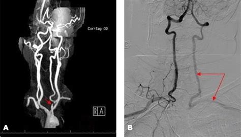 Causes Subclavian Steal Syndrome