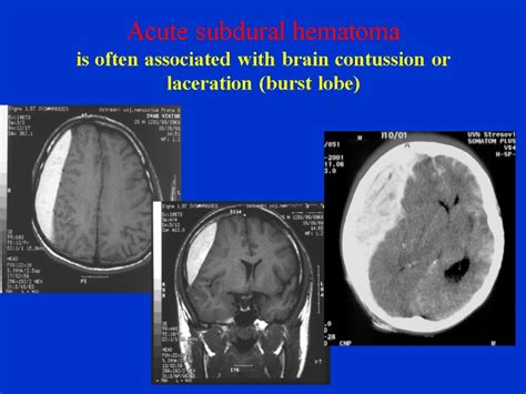 Craniocerebral Injury Jaroslav Plas Dept Of Neurosurgery 1st