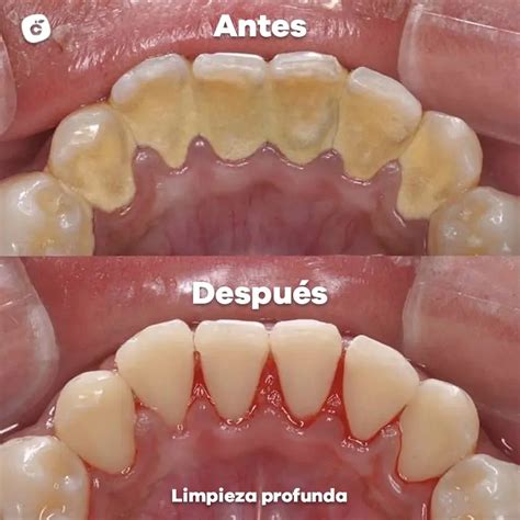 ¿qué Es Una Limpieza Dental Profunda Y Cuándo Hay Que Hacerla