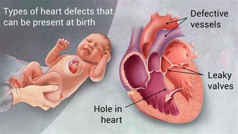 Congenital Heart Disease Chd How To Guide Tips And Tricks